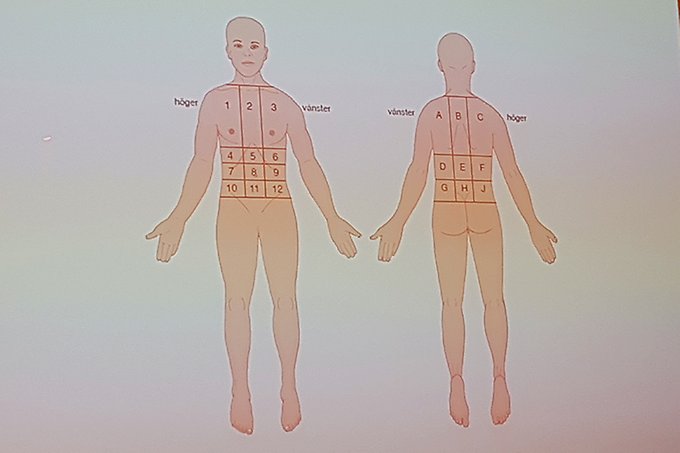En anatomisk karta som visar bak- och framsidan på människokroppen. Kroppsdelarna är markerade med olika bokstäver och siffror. 